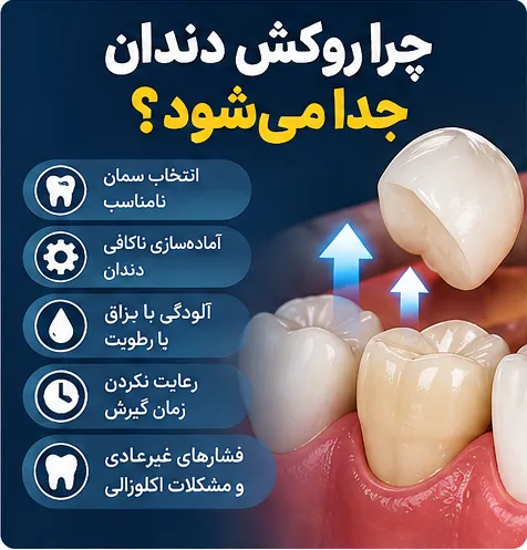 دلایل جدا شدن روکش دندان شامل سمان نامناسب، آلودگی به رطوبت و آماده سازی ناکافی دندان